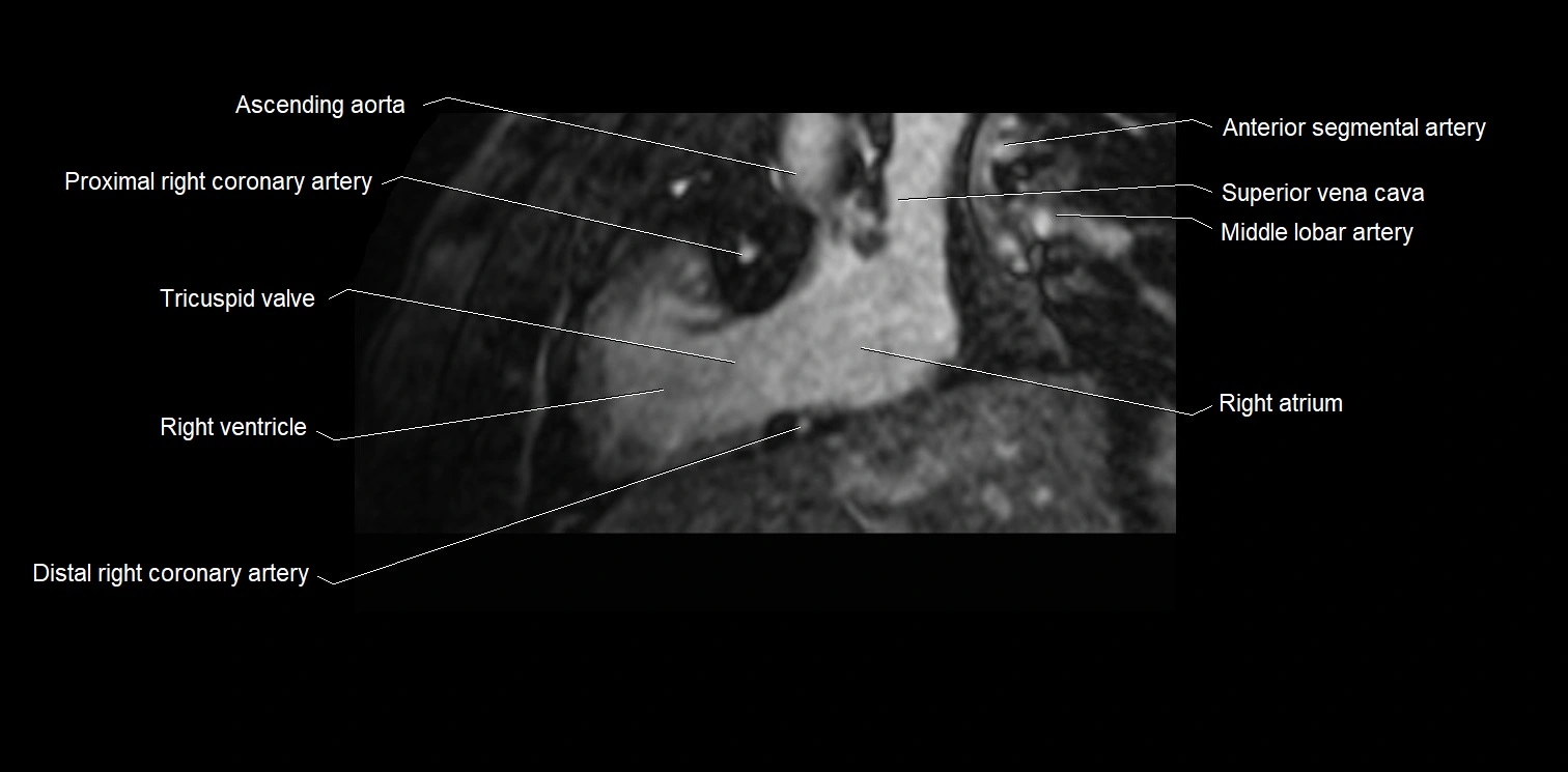 MRI heart and coronary arteries two chamber(sagittal)  anatomy image 10.webp